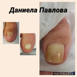 Медицински педикюр (снимка)